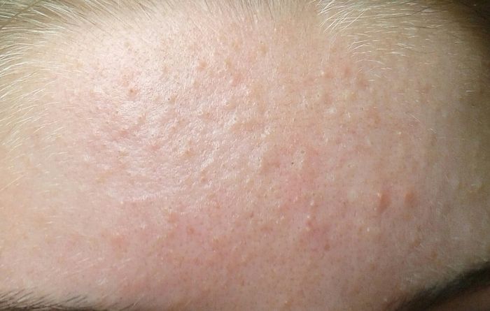 Mụn ẩn thường hình thành đám dưới da