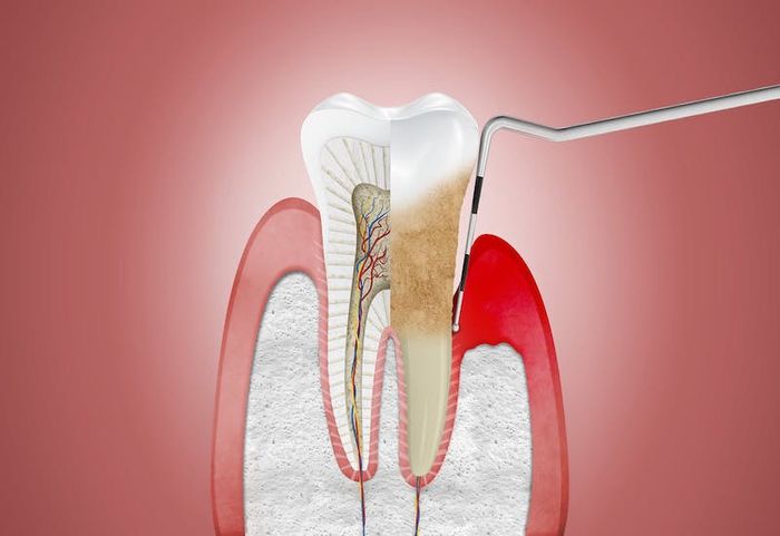 Nếu không chăm sóc răng miệng đúng cách, có thể gây ra viêm nha chu nặng