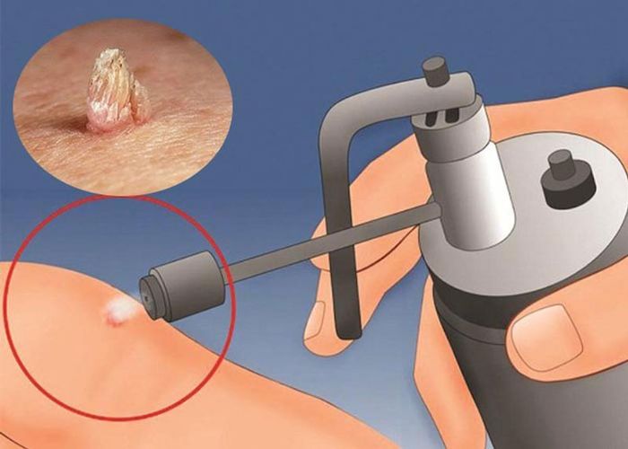 Thủ thuật sử dụng nitơ lỏng giúp đóng băng các tế bào nhiễm bệnh