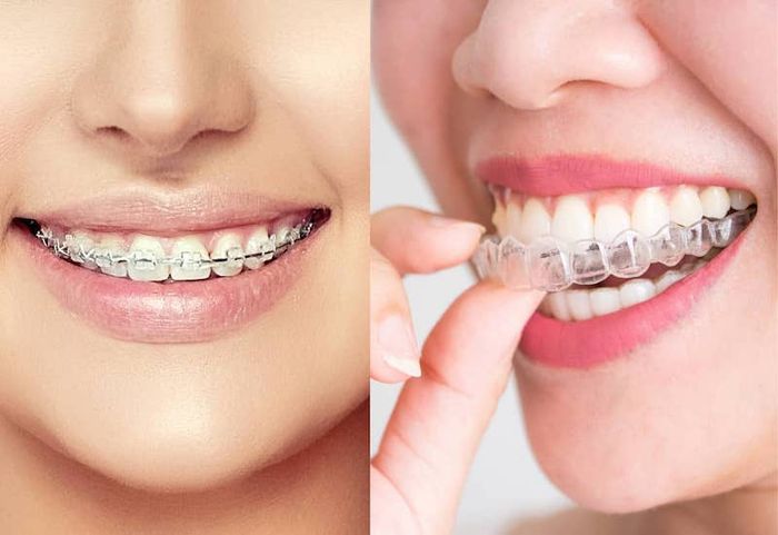 Sự khác biệt giữa niềng răng truyền thống (trái) và niềng răng invisalign (phải)