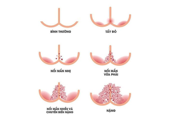 Nhận biết các cấp độ hăm da ở trẻ em