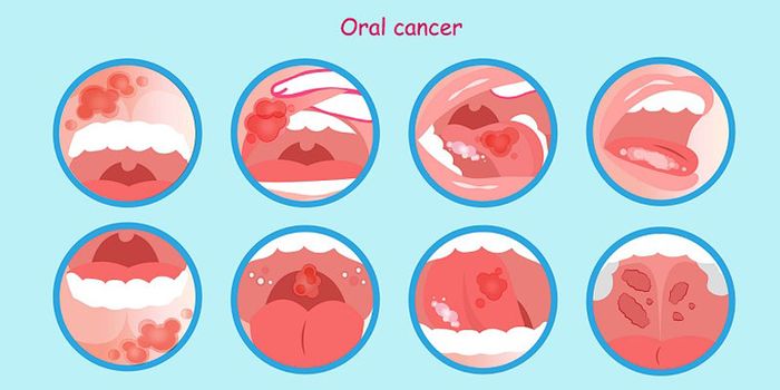 Mụn thịt là dấu hiệu nhận biết của bệnh ung thư trong khoang miệng