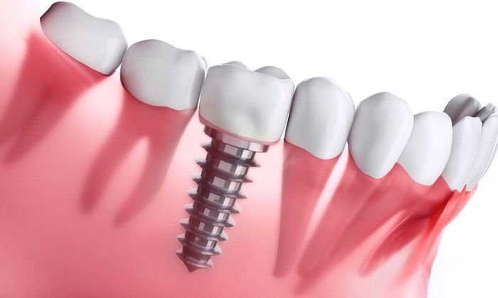 Cấy ghép implant không gây ảnh hưởng đến các răng bên cạnh