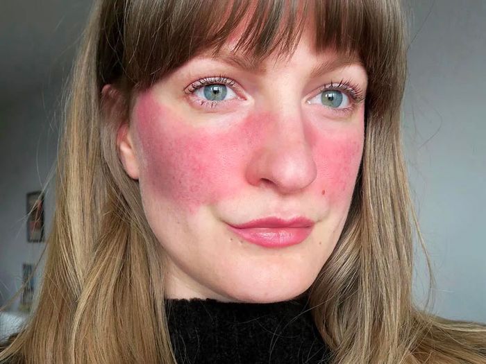 Peptide được kích hoạt liên quan đến sự hình thành của Rosacea.