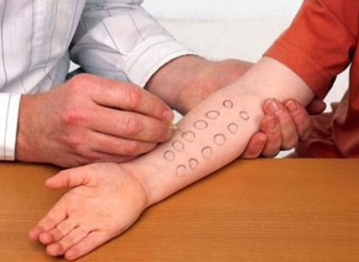Kiểm tra dị ứng - một trong những loại xét nghiệm thường được thực hiện khi khám da liễu