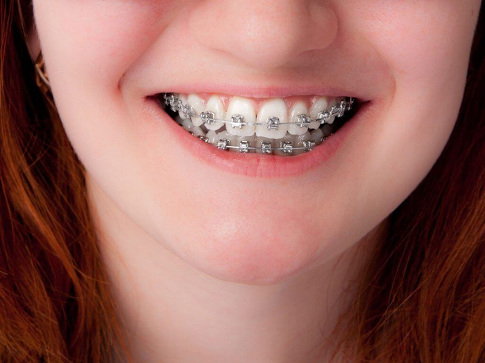 Nếu răng vẩu do vị trí của răng, có thể niềng để điều chỉnh