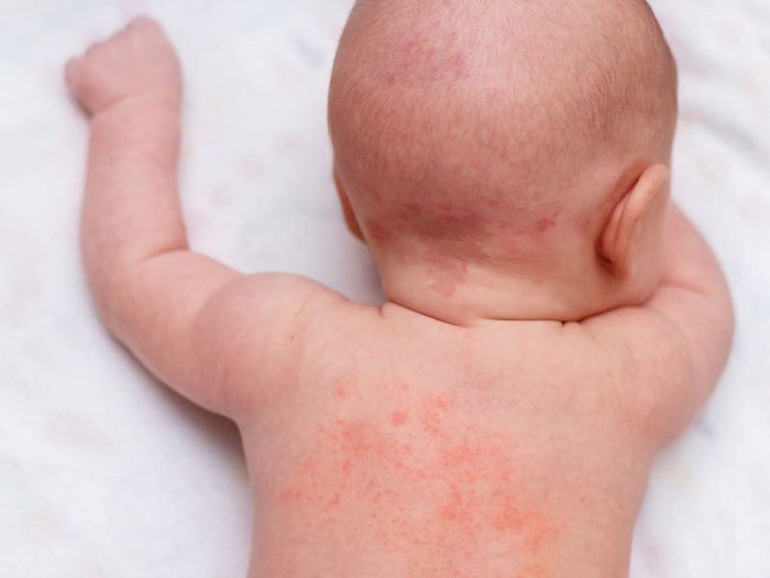 Rôm sảy thường là vấn đề da liễu phổ biến ở trẻ em trong mùa hè.