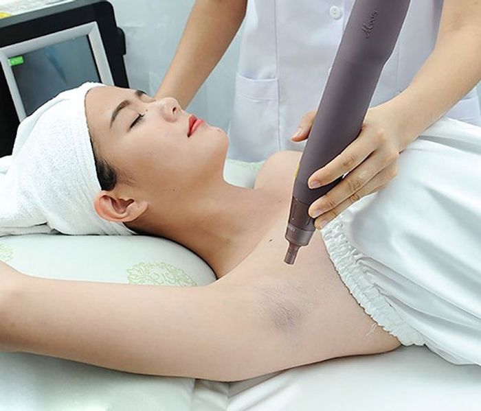 Xử lý vết thâm nách bằng phương pháp laser thẩm mỹ