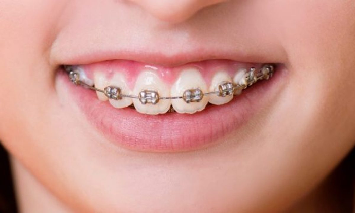 Răng vẩu hở lợi tạo cảm giác răng ngắn bất thường