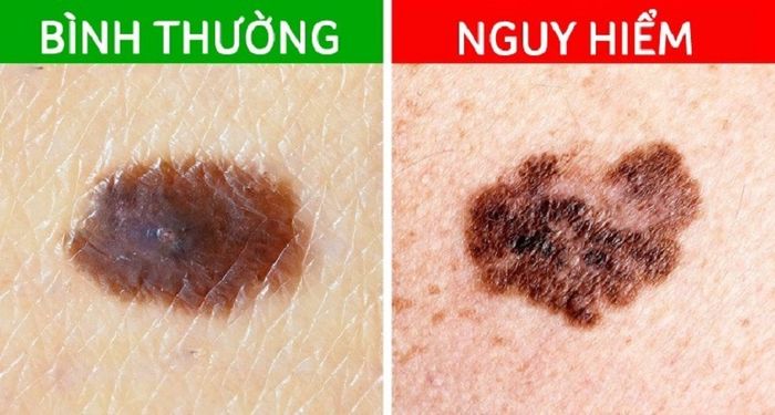 Điểm khác biệt giữa nốt ruồi lành và ác tính