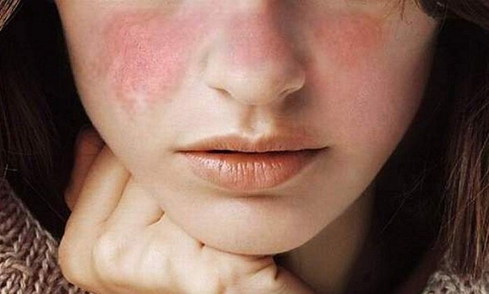 Những người mắc bệnh lupus ban đỏ thường có hiện tượng da nổi mẩn đỏ nhưng không ngứa