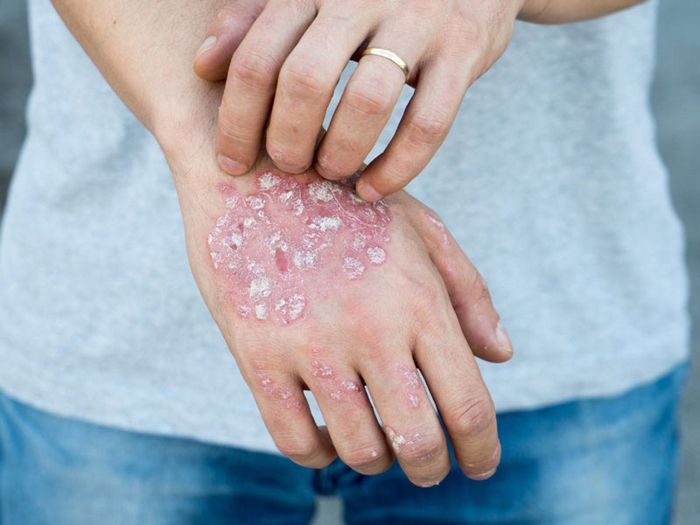Triệu chứng của bệnh nấm da có thể gây ra những hậu quả đáng kể cho sức khỏe.