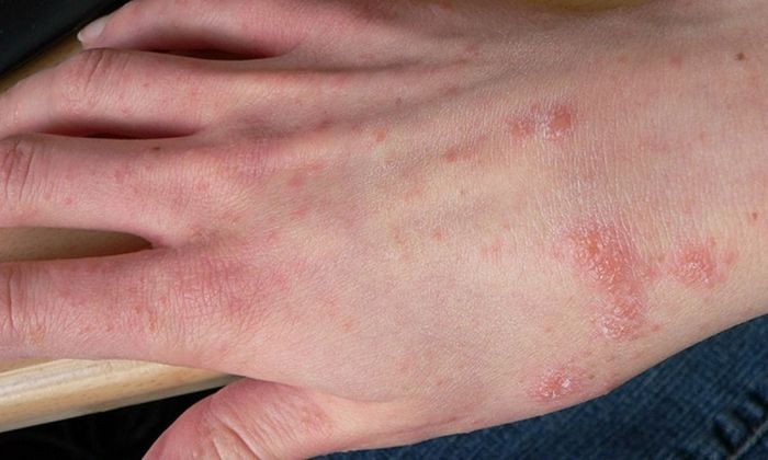Nhiều người thường gặp phải vấn đề ngứa, phát ban, đỏ, bong tróc da