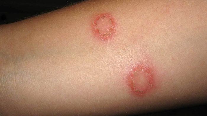 Vảy nến hình đồng tiền có thể xuất hiện phân tán trên cơ thể khi bị