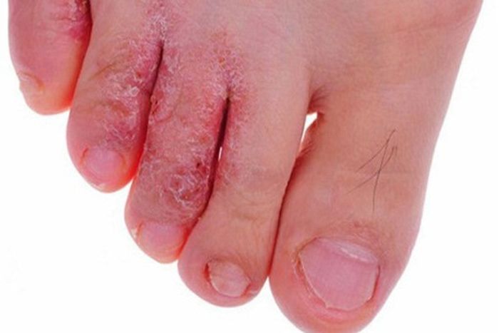 Nấm kẽ chân khiến người bệnh cảm thấy ngứa rát, không thoải mái
