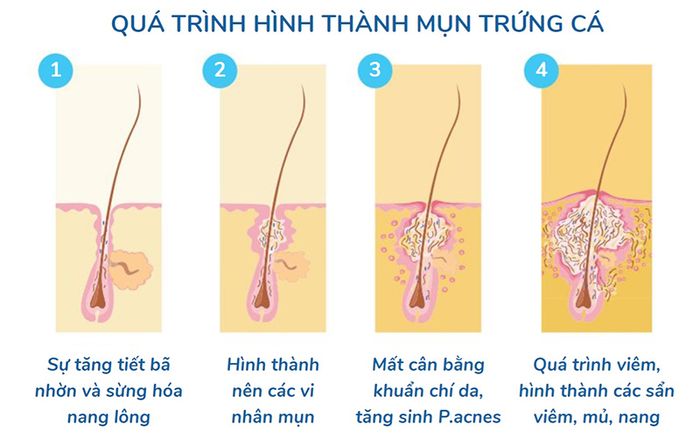 Quá trình phát triển của mụn trên bề mặt da