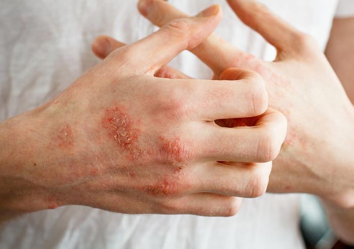 Vảy nến ở vùng nách gây cảm giác ngứa ngáy, không thoải mái
