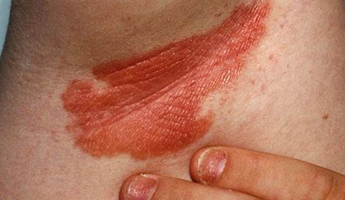 Những vùng có rãnh gấp thường là nơi mà loại vảy nến này xuất hiện phổ biến