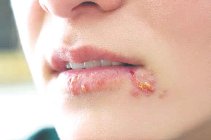 Nốt sần, dấu vết của virus Herpes tàn bạo