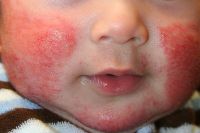 Viêm da dị ứng có thể phát sinh ở trẻ sơ sinh