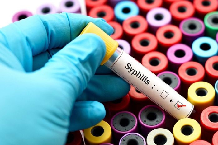 Kiểm tra Syphilis giúp xác định bệnh giang mai