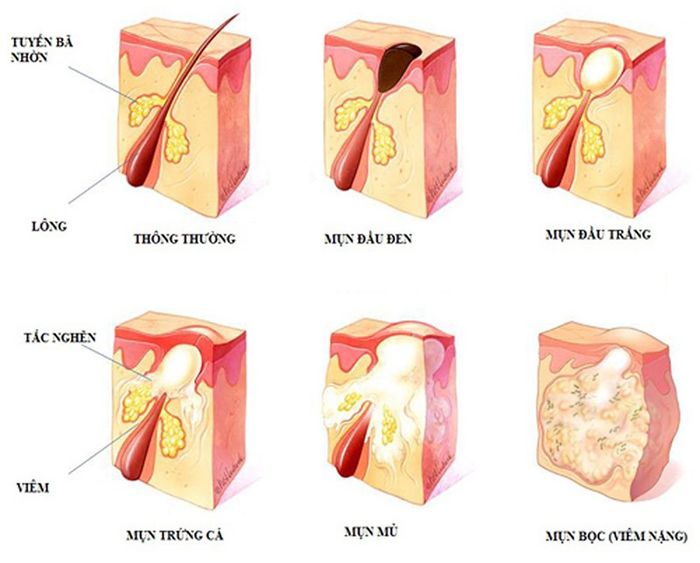 Khi mụn trứng cá chuyển sang mức độ nặng tức là tình trạng trở nên nặng với số lượng nhiều và biểu hiện tồi tệ hơn