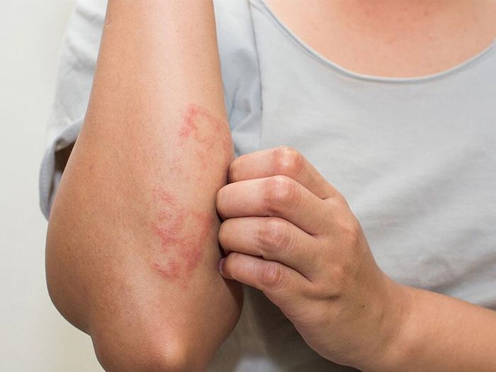 Viêm da tiếp xúc là kết quả của tác nhân gây kích ứng