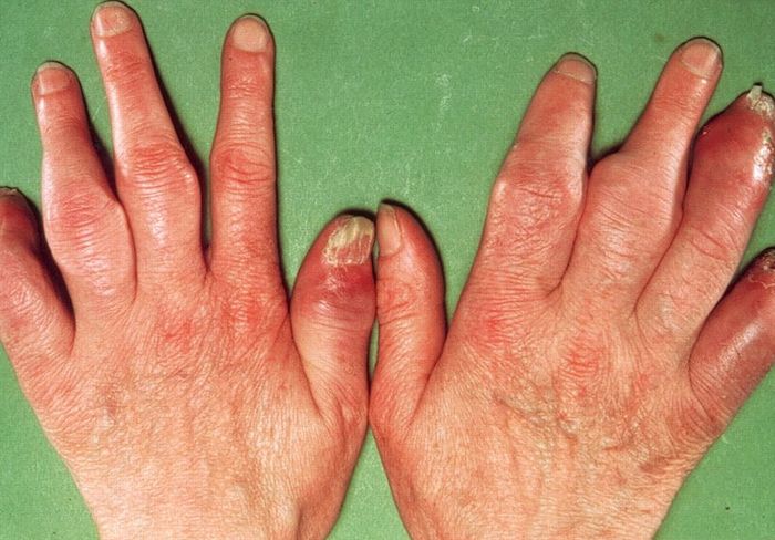 Vảy nến thể viêm khớp có thể gây ra những biến chứng nguy hiểm