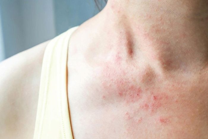 Viêm da không gây nguy hiểm nhưng lại có ảnh hưởng lớn đến vẻ đẹp tự nhiên.