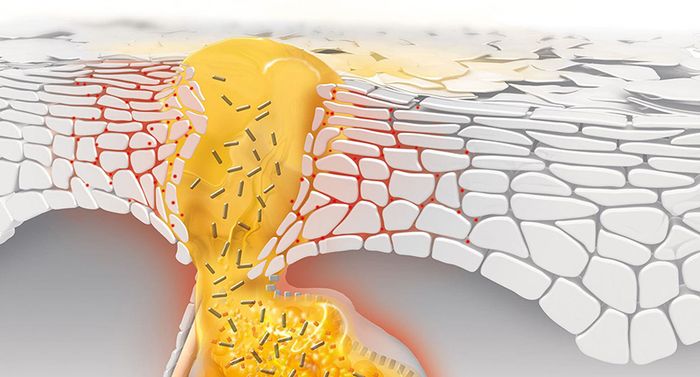 Sự tích tụ của chất nhờn và tế bào chết khiến lỗ chân lông bị bí, gây ra mụn.