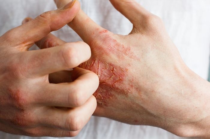 Dấu hiệu viêm da