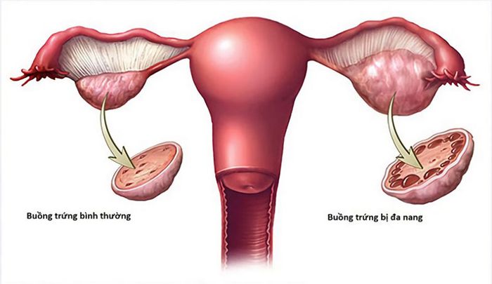 Tóc rụng và thưa có thể là dấu hiệu của bệnh đa nang buồng trứng.