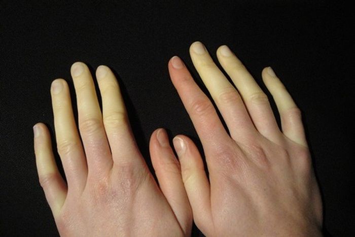 Người mắc bệnh Raynaud có thể gặp phải tình trạng da tay nhăn khi tiếp xúc với nước.