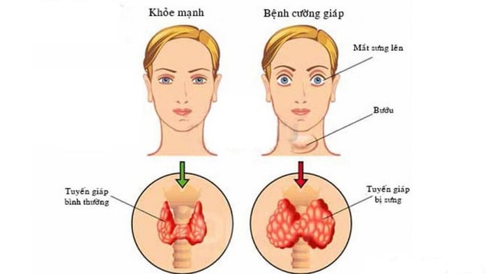 Bệnh cường giáp là nguyên nhân khiến ăn mãi không tăng cân.