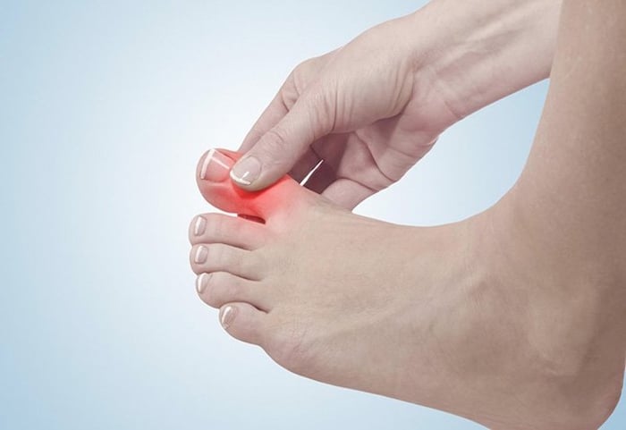 Bệnh Gout là một rối loạn chuyển hóa do axit uric trong máu tăng cao