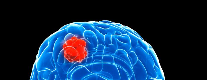 Glioblastoma Multiforme (GBM): Tiến Bộ Trong Điều Trị Cho Một Khối U Não Nguy Hiểm | Y Học Johns Hopkins