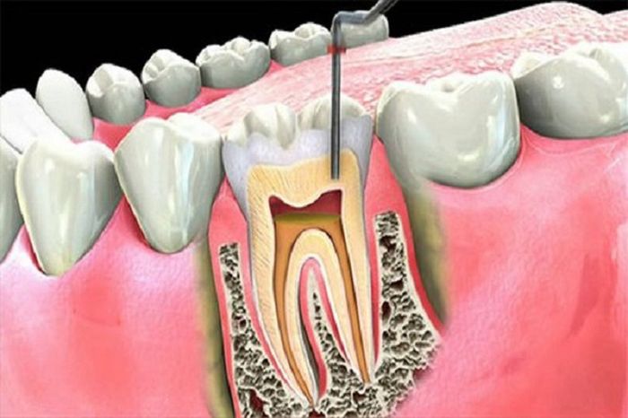 Lấy tủy răng giúp loại bỏ viêm nhiễm và ngăn ngừa sự lây lan sâu răng đến các răng láng giềng.