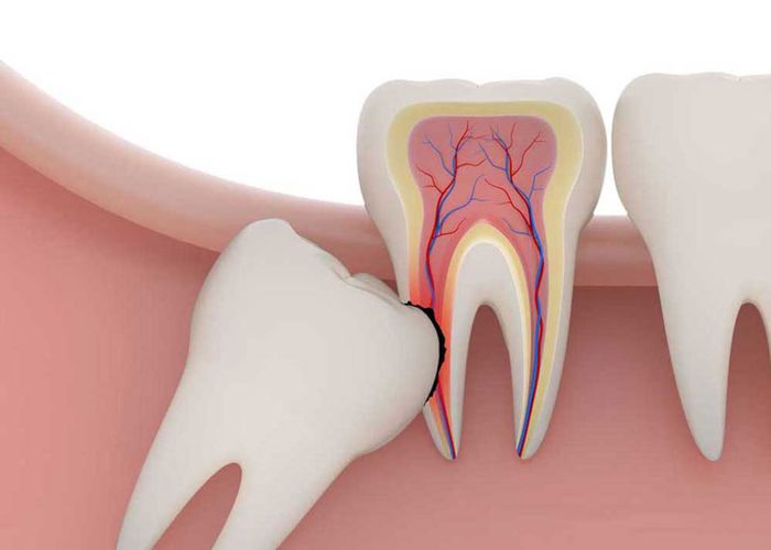 Răng khôn mọc sai vị trí