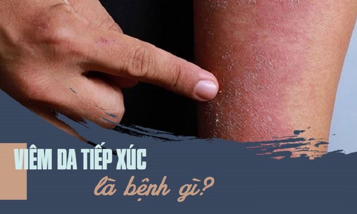 Viêm da tiếp xúc là căn bệnh gì?