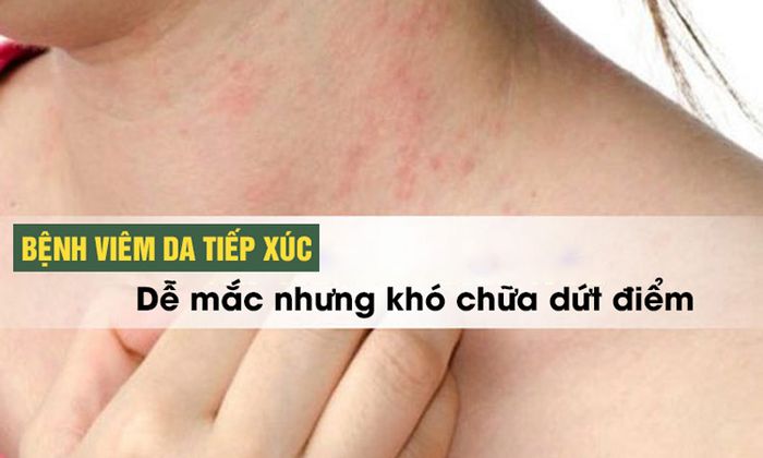 Mức độ nguy hiểm của bệnh viêm da