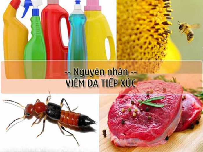 Nguyên nhân gây ra viêm da có thể là gì?