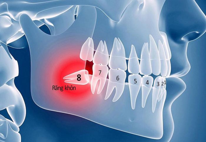 Khi nào thì cần nhổ răng khôn?