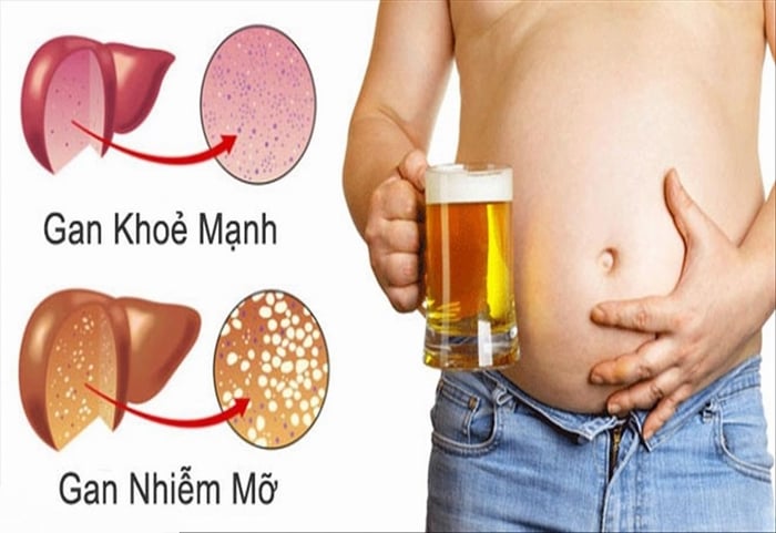 Cẩn thận với những biến chứng nguy hiểm của gan nhiễm mỡ