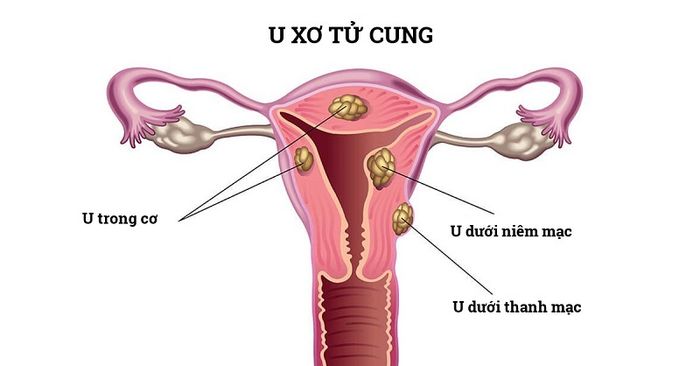 U xơ tử cung chủ yếu là khối u lành tính, thường gặp ở phụ nữ trên 30 tuổi