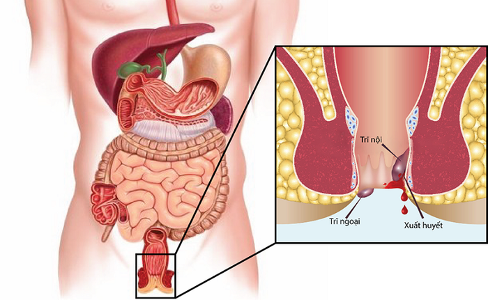 Người mắc bệnh trĩ nên tránh ăn ớt vì có thể làm tăng nguy cơ xuất huyết búi trĩ.