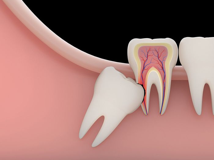 Răng khôn mọc không đúng vị trí gây ảnh hưởng đến chức năng ăn uống và sức khỏe răng miệng nên nhiều người mong muốn loại bỏ chúng