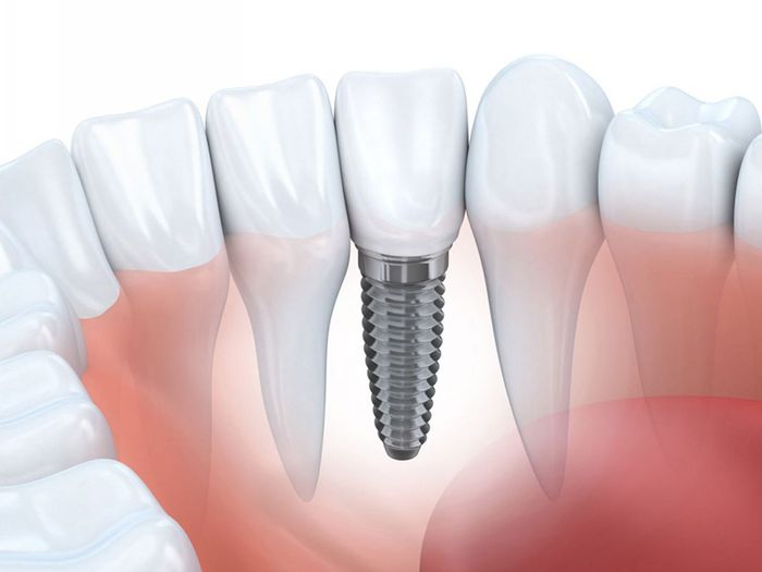 Cấy ghép implant là phương pháp nha khoa hiệu quả nhất hiện nay để thay thế răng thật