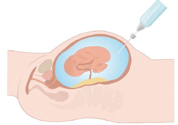 Sau khi kết quả kiểm tra NIPT phát hiện độ lệch, mẹ bầu nên thực hiện kiểm tra dịch ối để kiểm tra nhiễm sắc thể đồ