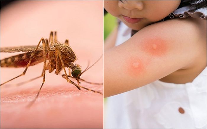 Muỗi là nguyên nhân gây ra bệnh sốt xuất huyết Dengue