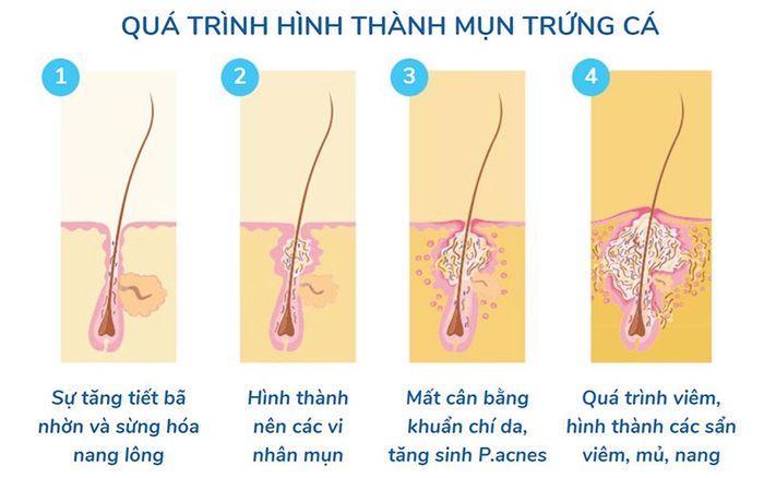 Quá trình hình thành mụn trứng cá